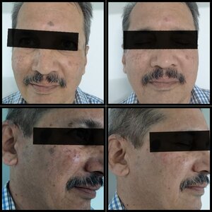 Seborrhoic keratosis removed with laser.