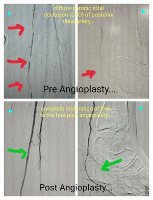 Photo : Angioplasty- Pre and Post