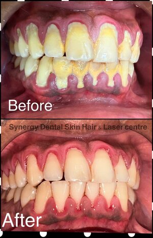 Before After Results