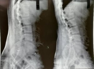 Dr. Ajay Kothari - Spine Surgeon - Shivaji Nagar, Pune