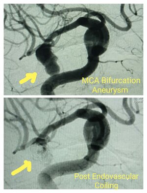 Photo : MCA bifurcation Aneurysm - Pre Procedure &amp; Post Endovascular Coiling