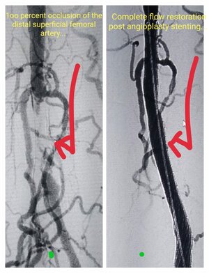 Photo : Superficial Artery stenting- Pre Procedure &amp; Complet blood flow restoration post stenting
