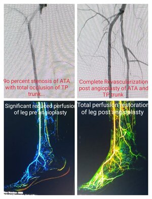 Photo : Angioplasty- Pre and Post