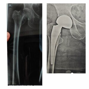 Pre &amp; Post-Op Xray: Femur Neck Fx