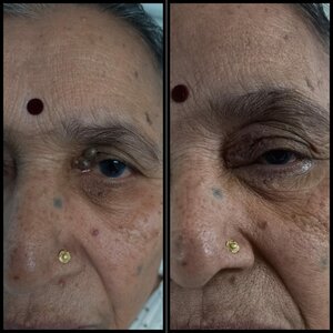 Senile Comedones removed with a simple laser technique.