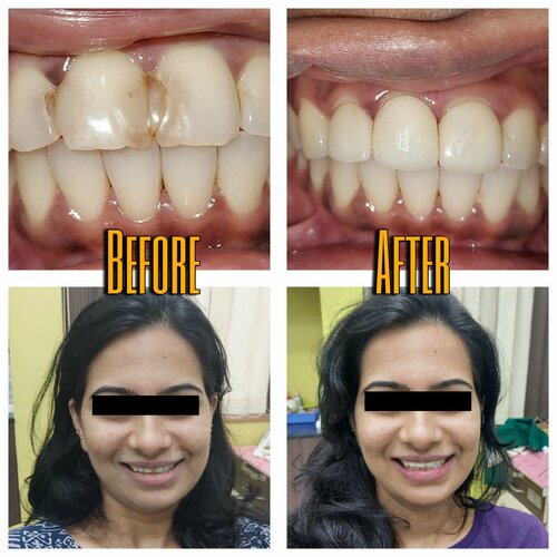 Ceramic Veneers | Results|Unique children's clinic and Dental Implant Center|Karvenagar,Pune